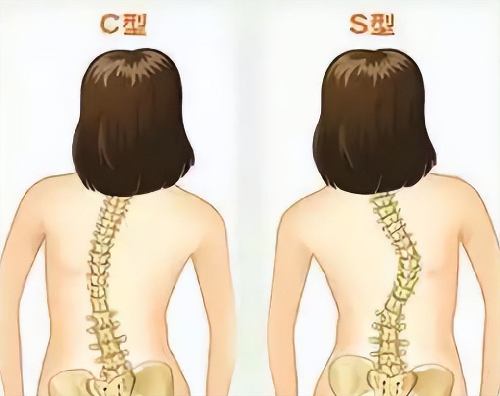 脊椎侧弯 对比图片