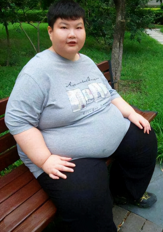 2014年江西14岁男孩胖到300斤医生查出罕见病手术意外连连