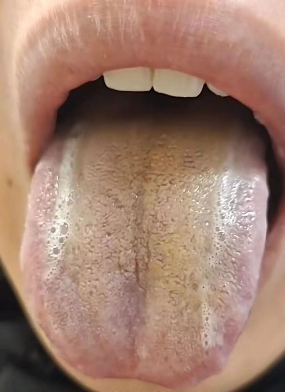 舌苔黄白之谜:真寒假热与肝胆湿热的鉴别  遇到这种舌苔表现,一定要