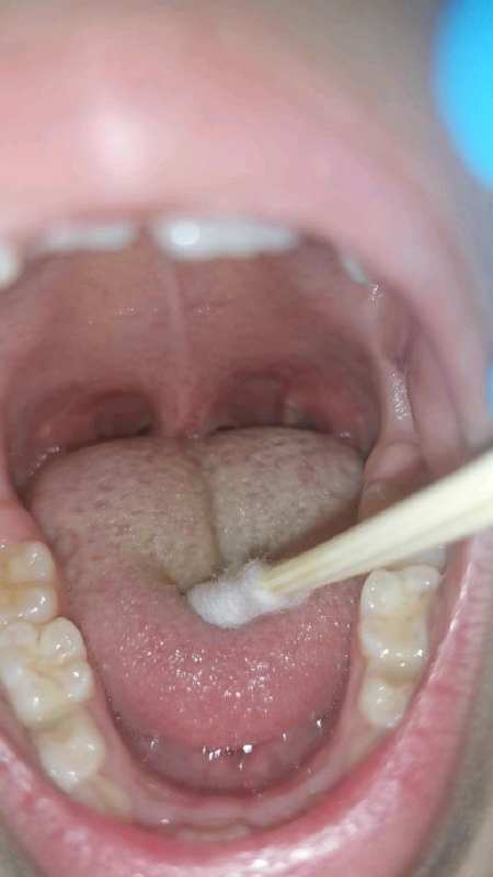 扁桃体术后一周还在脱膜中