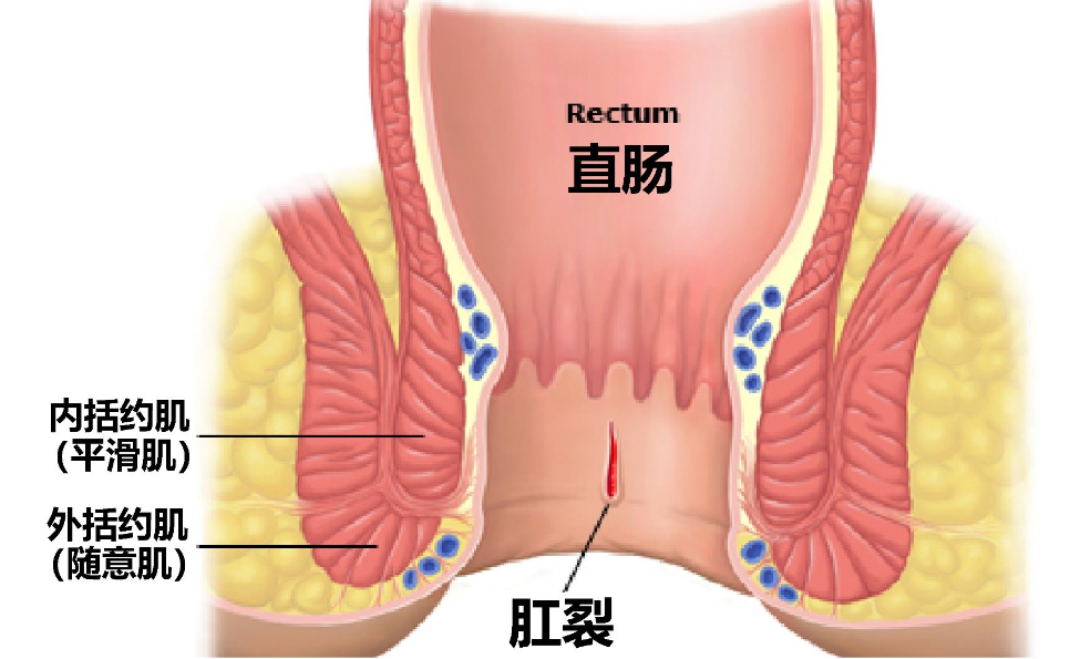 肛裂的症状正常图片