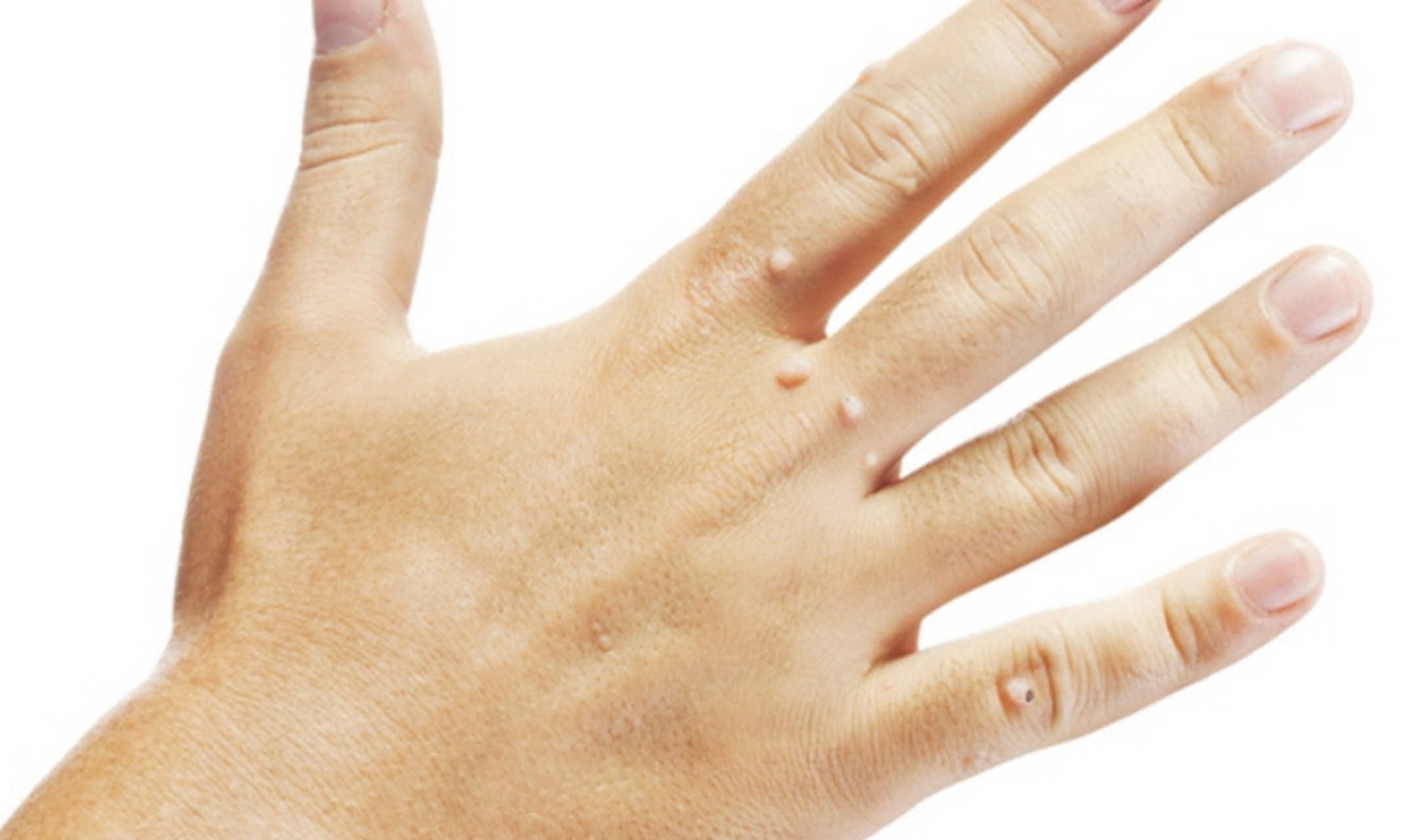 身上长这种小疙瘩可能是hpv病毒感染  扁平疣是皮肤粘膜感染人乳头瘤