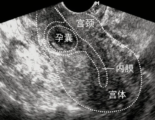 可见滋养层子宫超声图像方位讲解图子宫超声宫颈妊娠超声检查正常子宫