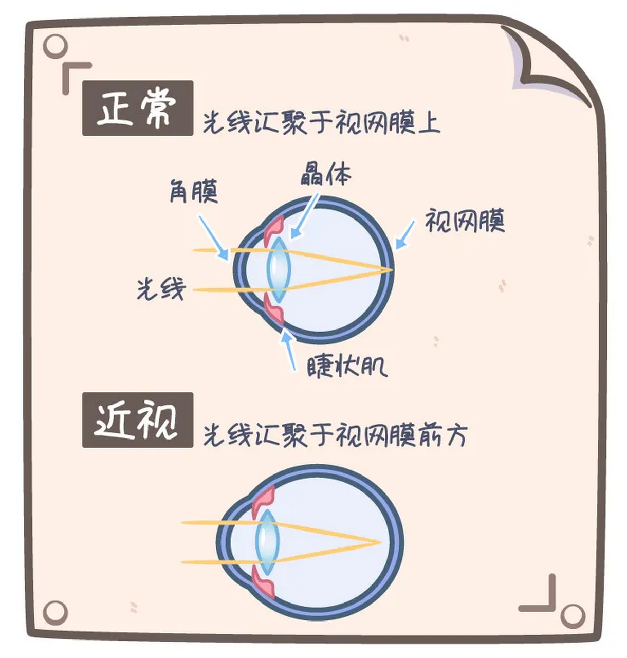 近视的成因是什么?#近视