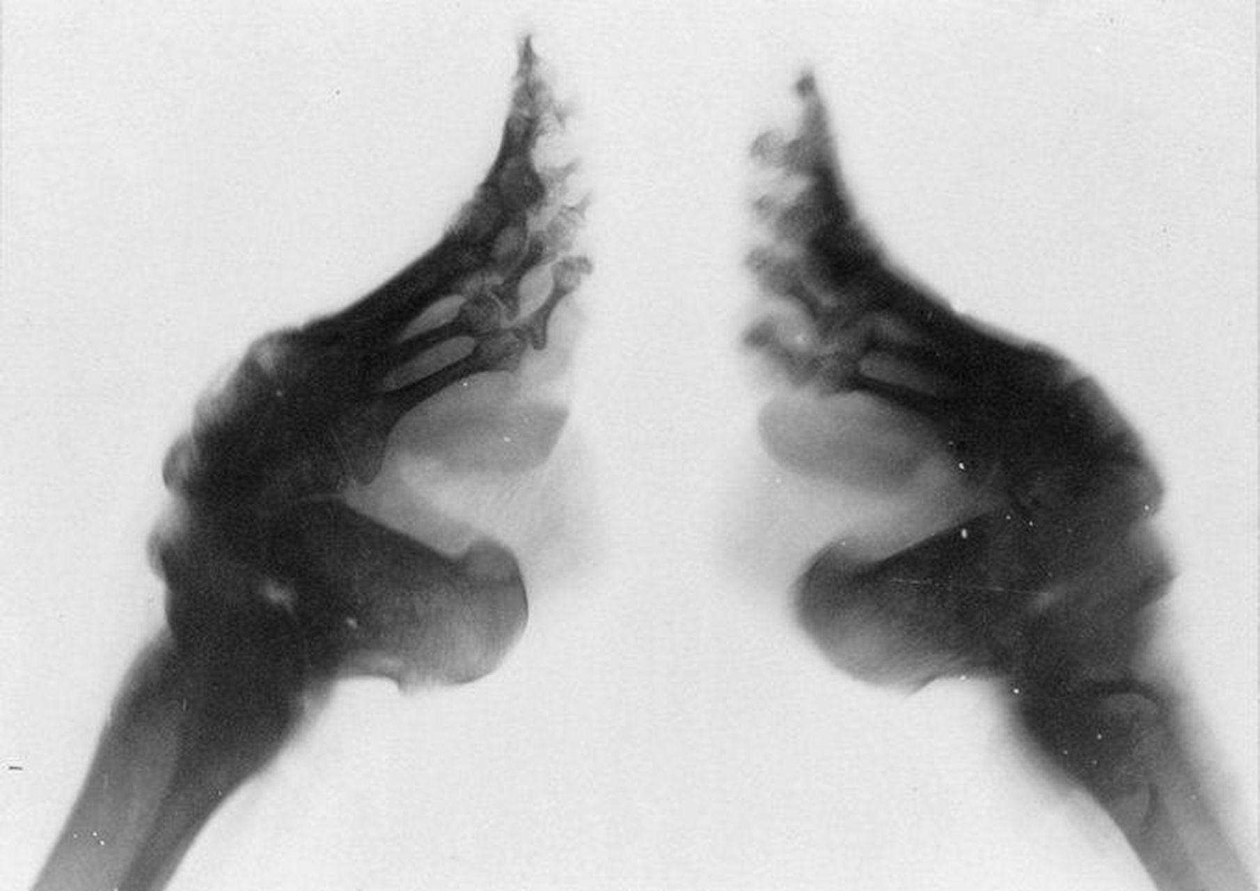 裹足后,脚的x光是这样的.  看着都非常的疼.