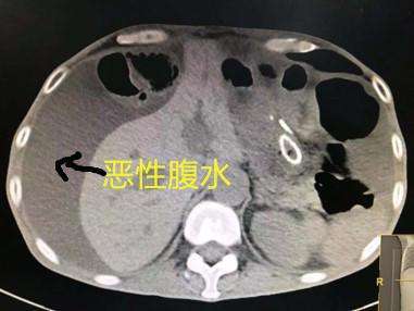 肝硬化出现腹水还能治好吗?有什么好的办法?