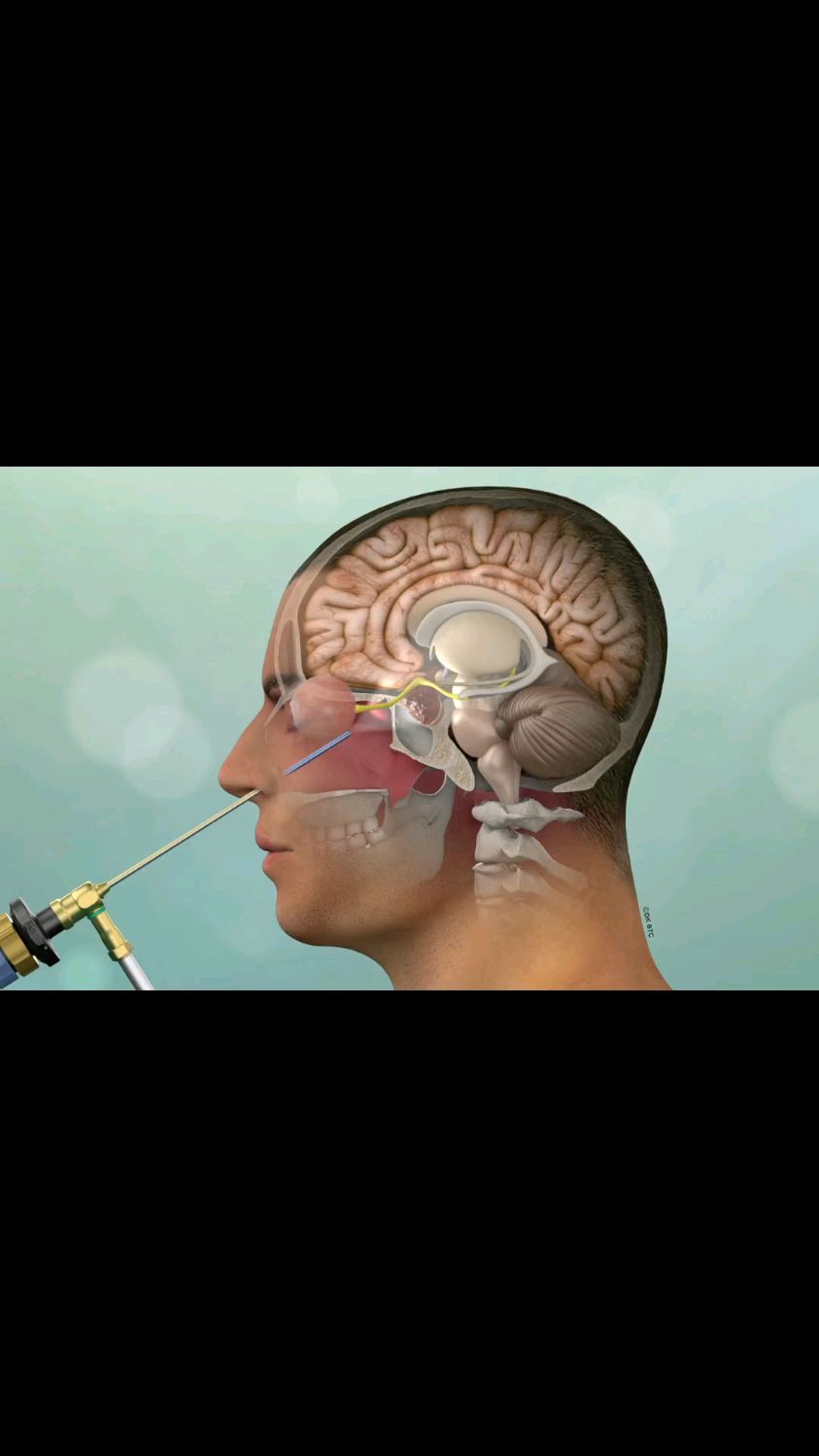 a case of pituitary adenoma operated via endoscope