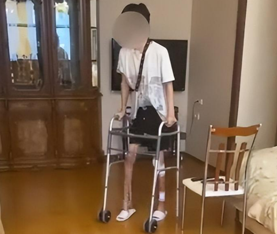 李亚诺做完"断骨增高手术"初苏醒时还在麻药的效果中,并没有太多不适
