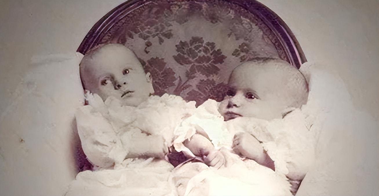 1908年一连体姐妹出生英国姐姐死后妹妹与遗体共存2天去世