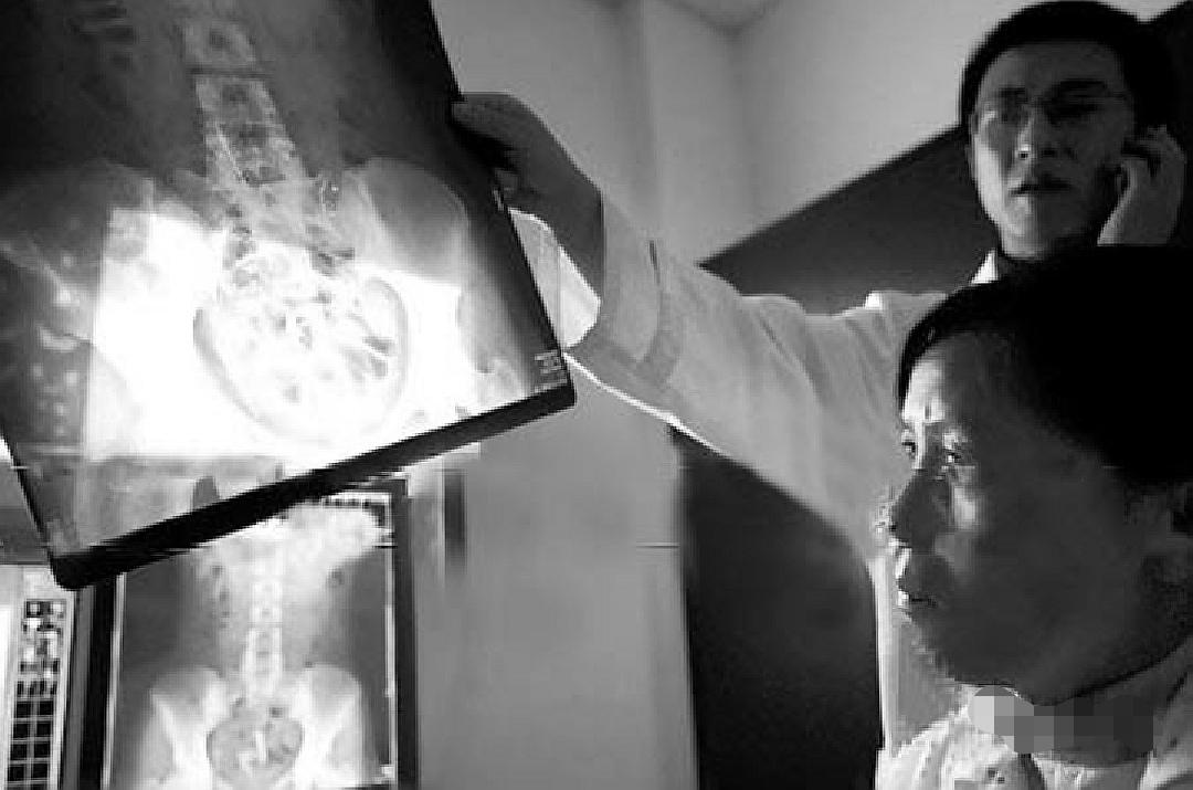 2004年云南农妇体内发现26根缝衣针医生1岁之前扎入的