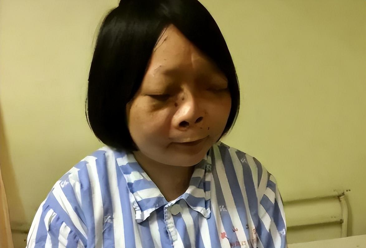 回顾马面女孩吴小燕纱巾蒙面13年面部手术取2公斤肿物后迎爱情