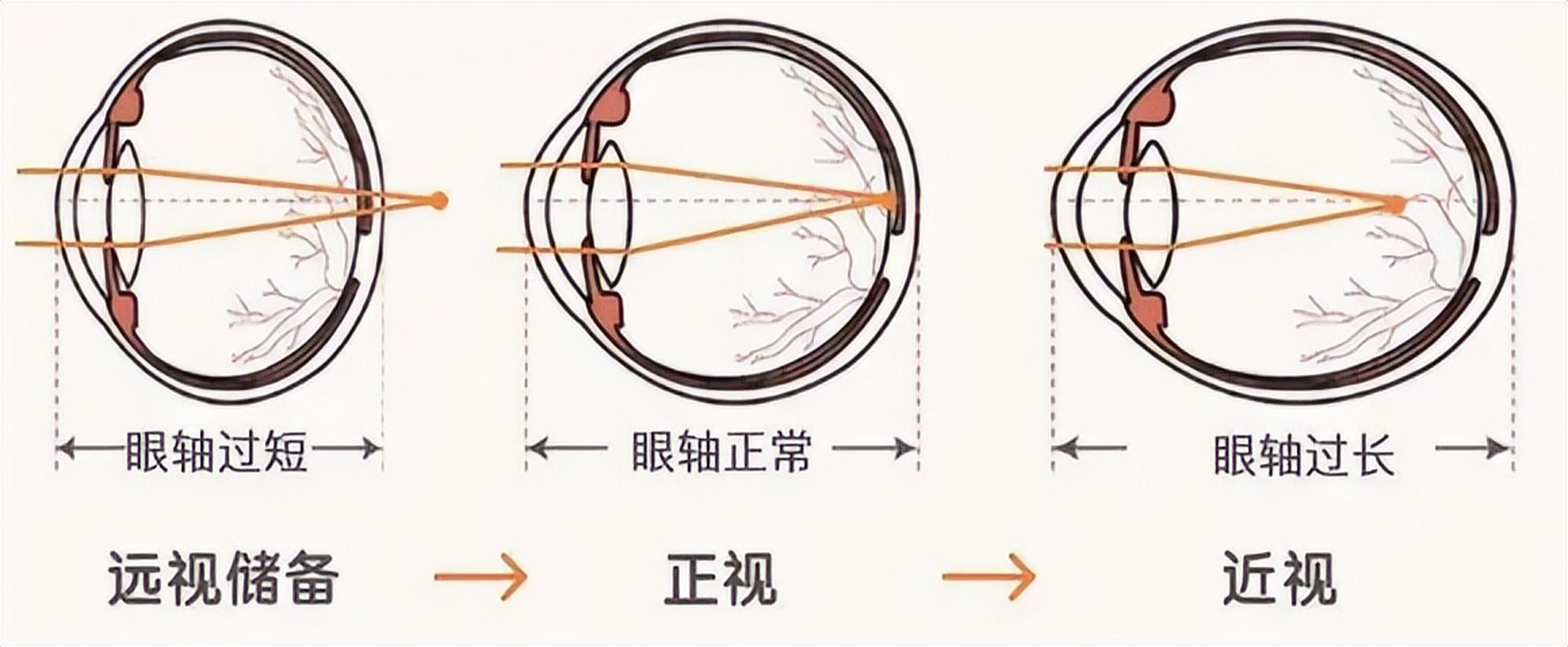 除了关注裸眼视力,还应关注远视储备,它是预防近视的关键