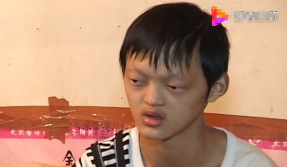 重庆惊现吸血鬼少年一对獠牙嗜水如命医生掰开嘴发现真相