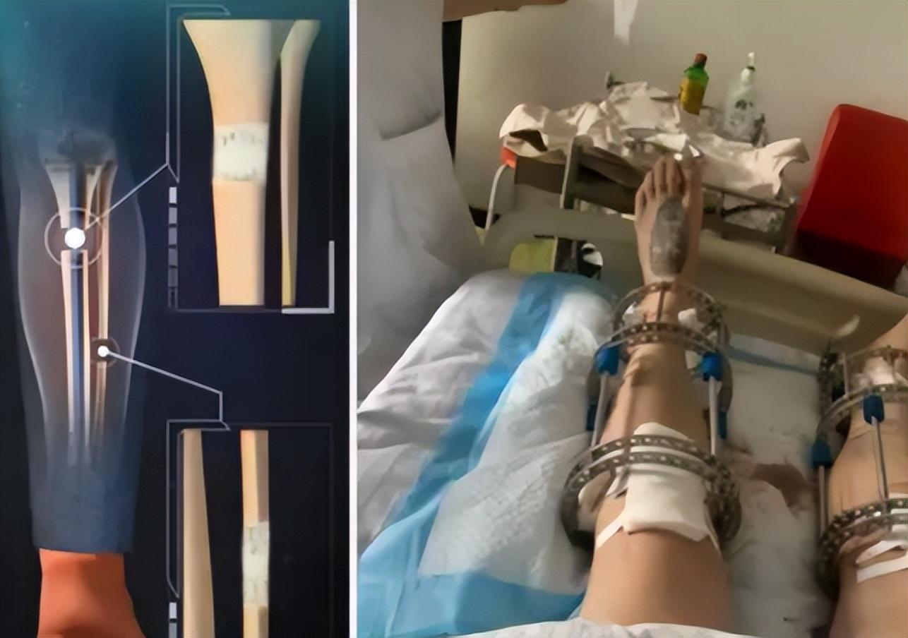 传闻中的"增高术"