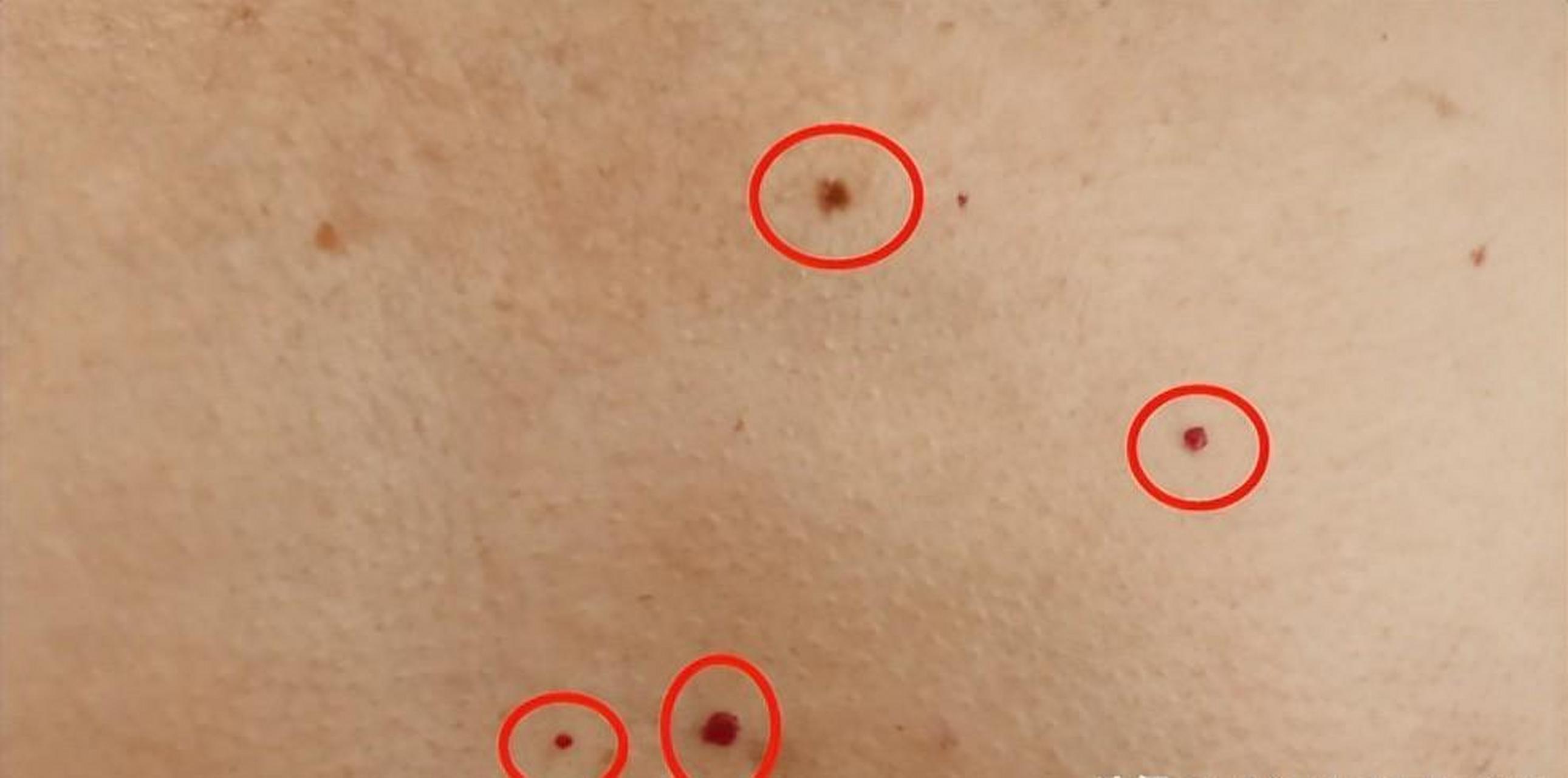 胸前长了几个"红痣",是不是肝脏不行了?