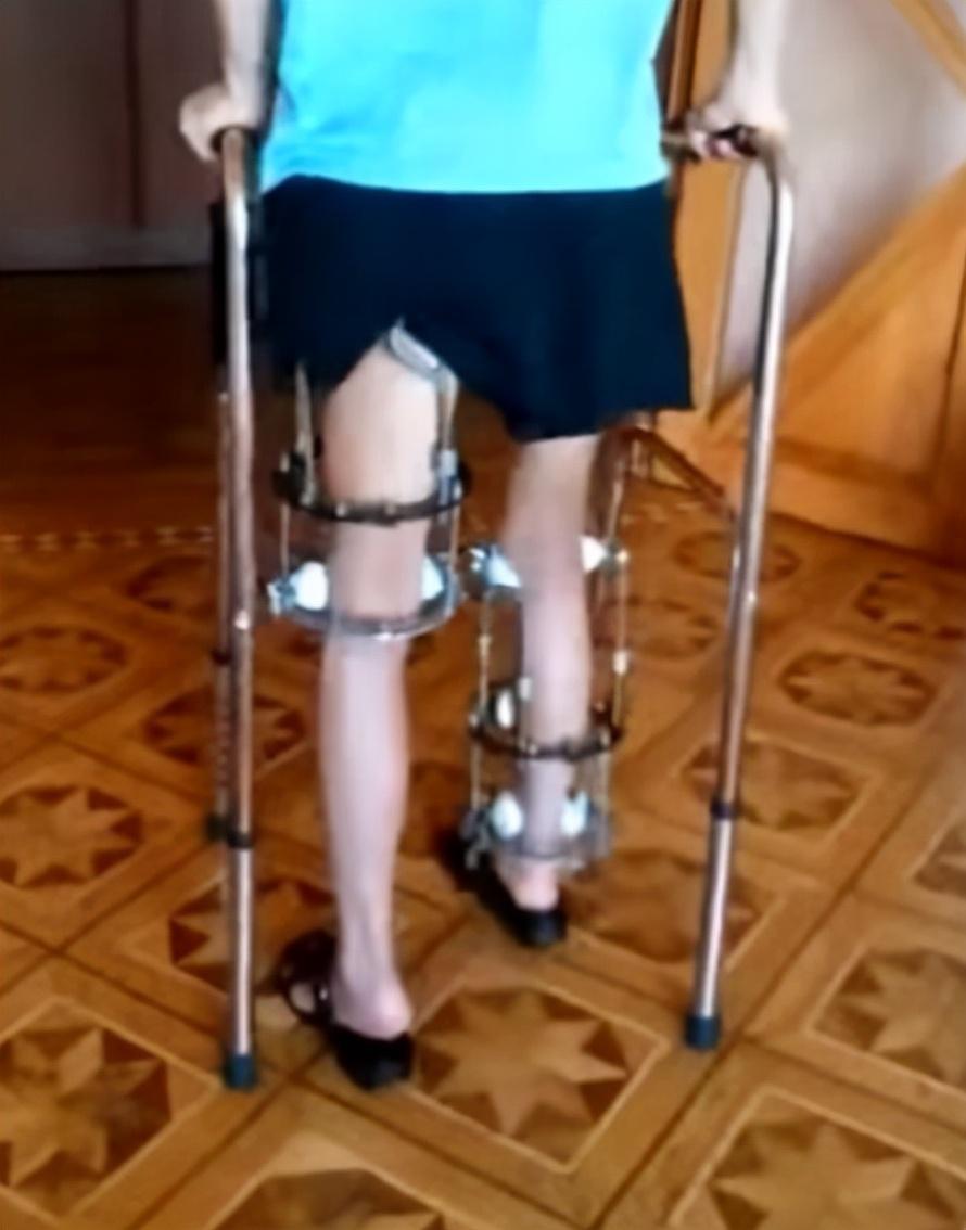 2014年20岁北京男孩李亚诺花16万断骨增高72厘米后来怎样