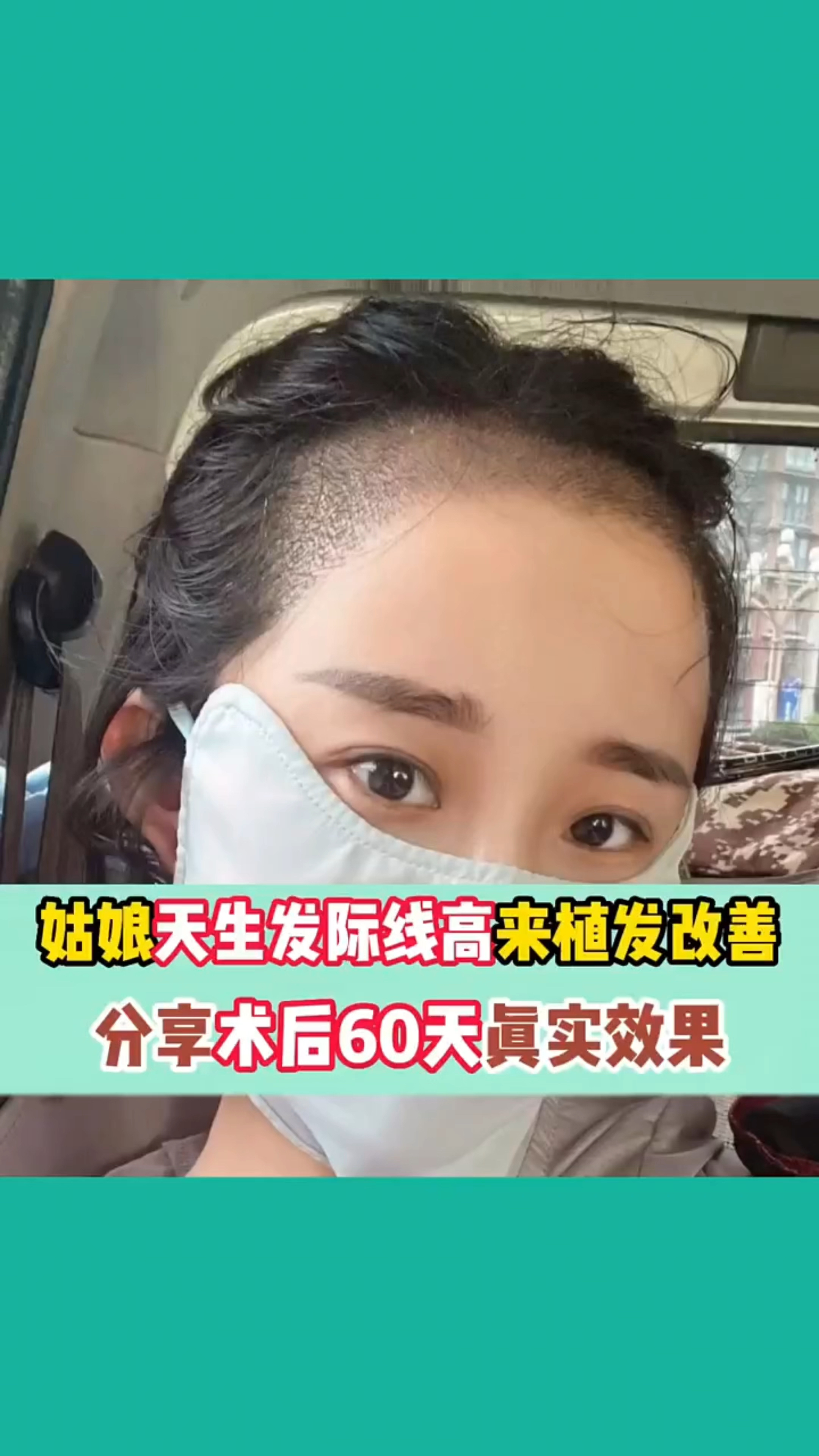 植发手术后还能脱头发吗(植发手术后还能脱头发吗女)