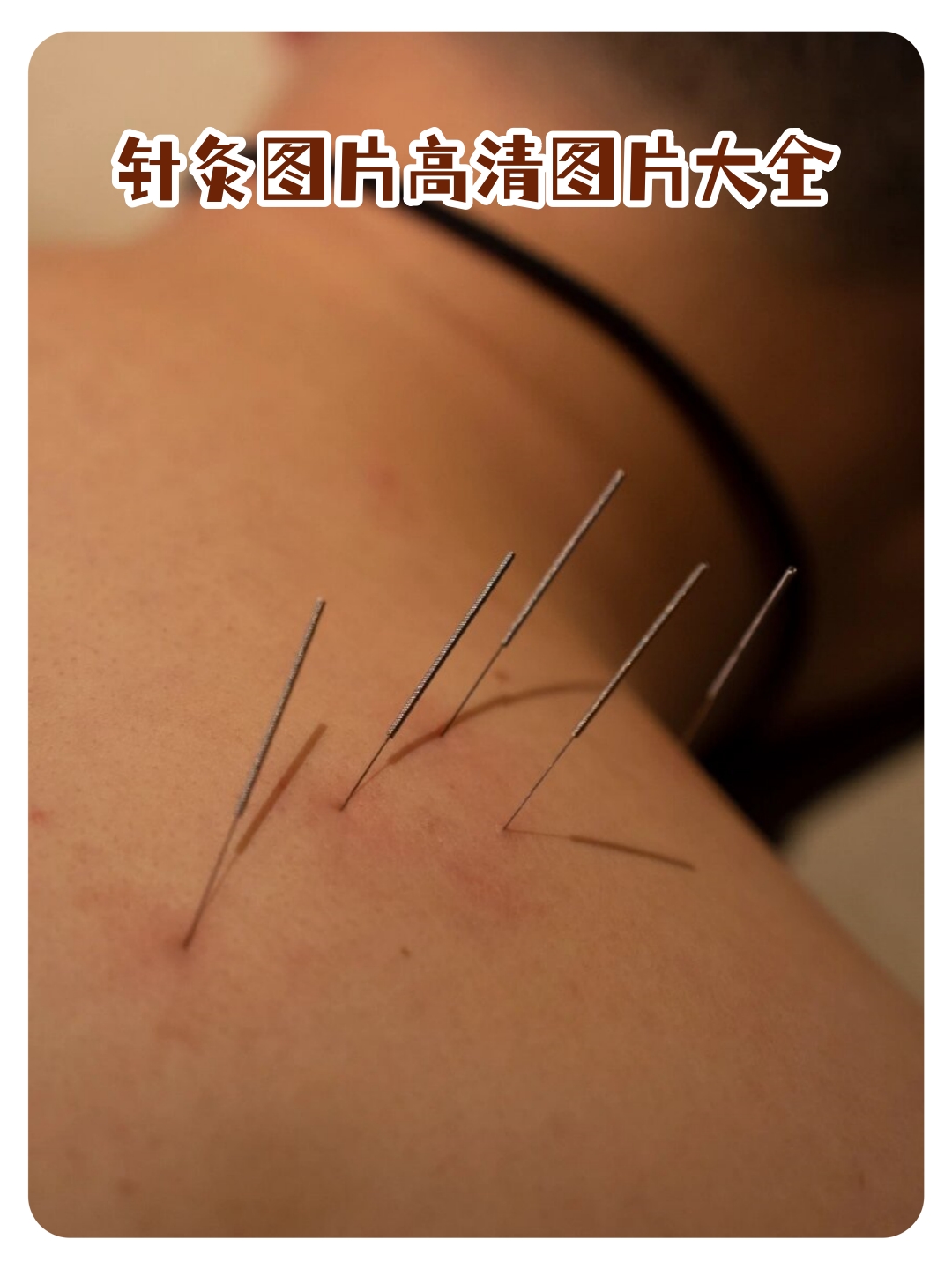 针灸源自悠久的中医传统,是一种通过刺激穴位来调整人体气血和脏腑