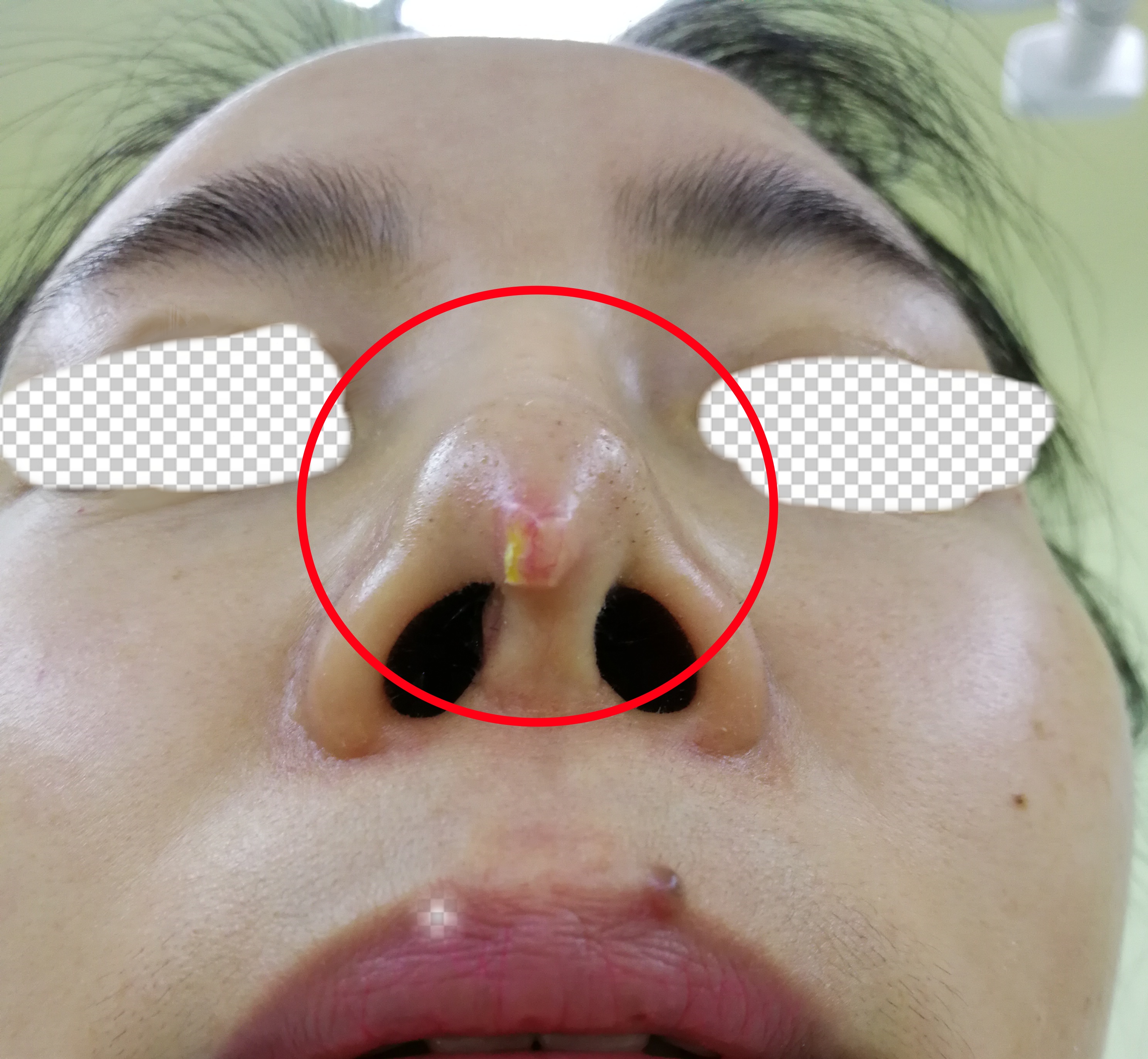 l型硅胶假体已经很少人做了,也不建议大家再去做这种很老的隆鼻方式