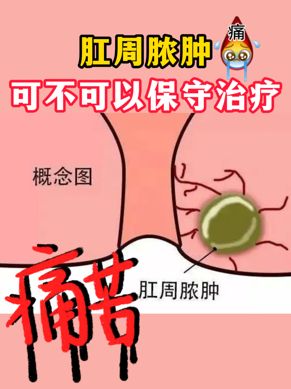 是一种常见的肛肠疾病,通常表现为肛门周围出现肿块并伴有剧烈疼痛