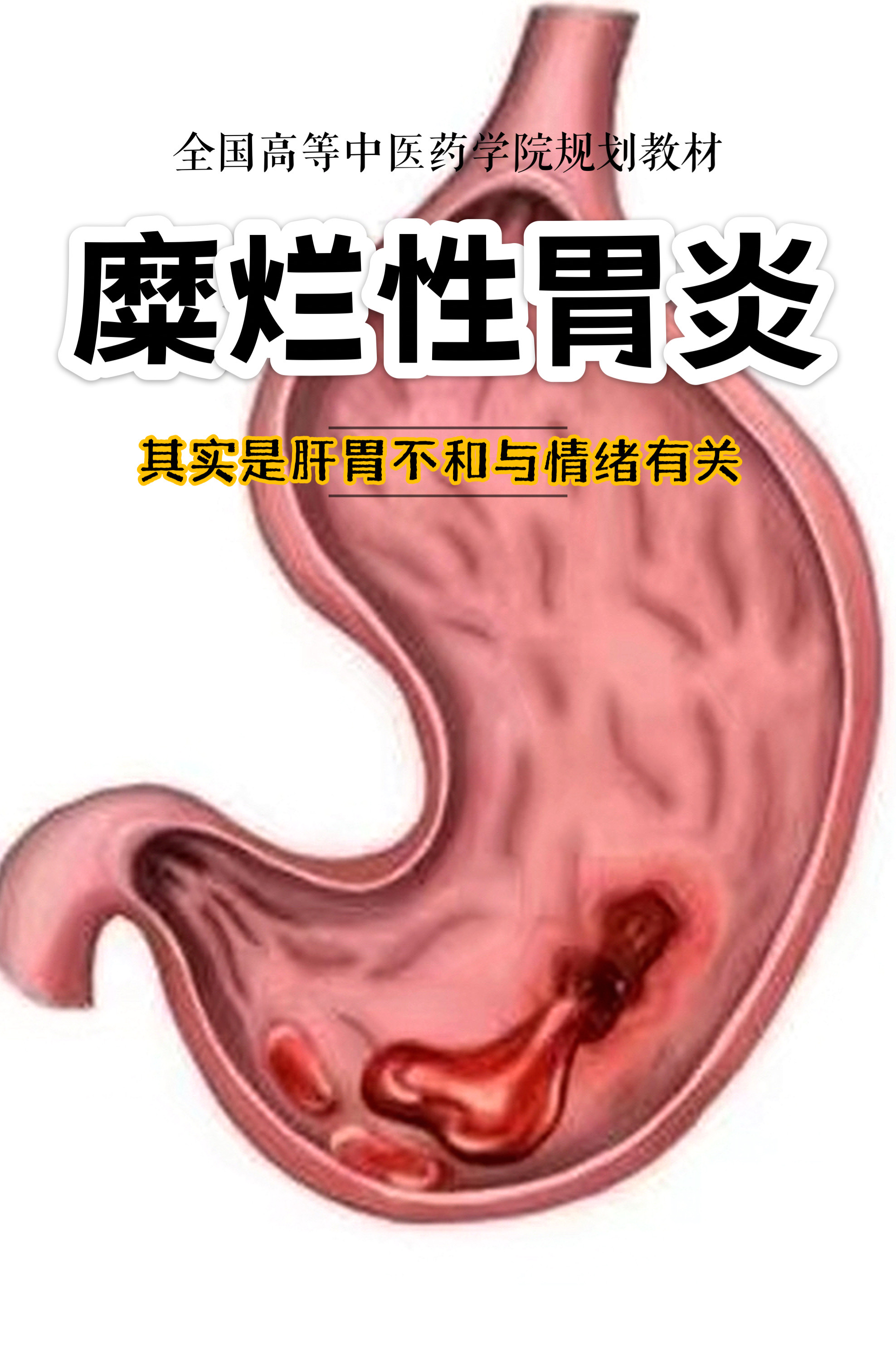 胃糜烂是怎么回事图片