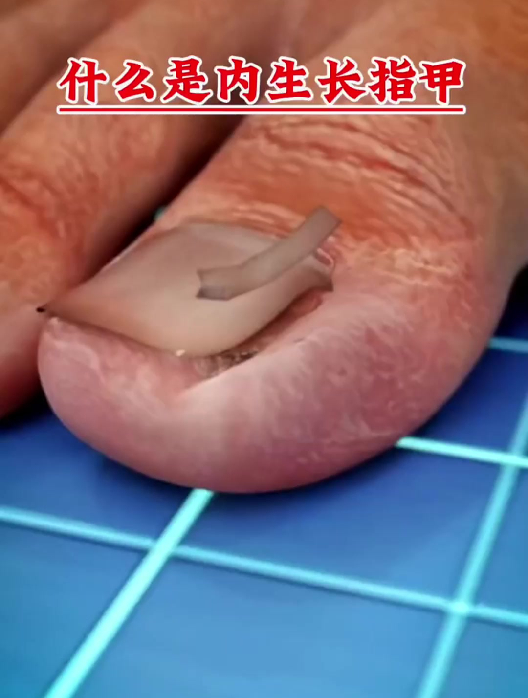 动态解释什么是"内生长"指甲-度小视