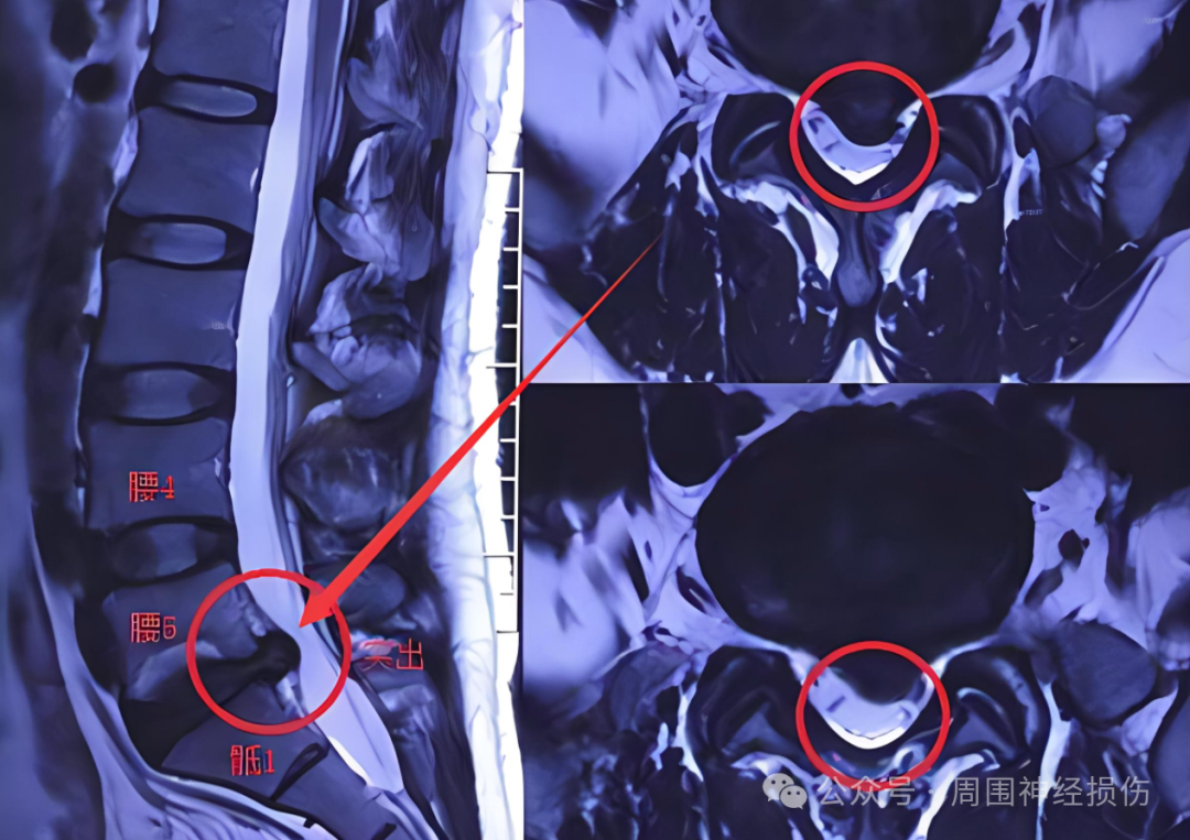 腰5骶1椎间盘突出压迫神经