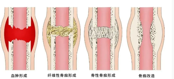 刺激骨痂生长的办法图片