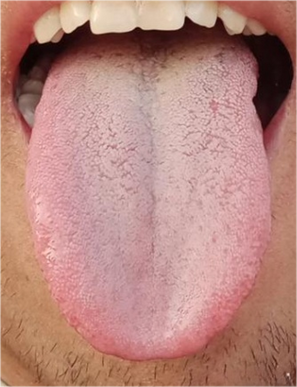 看这种舌头,不需要清湿热也不需要滋阴,直接补阳就可