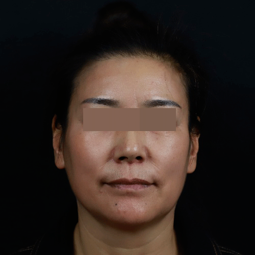 前几天,刚做了一台拉皮手术,取出的10多根线和奥美定不敢展示,怕吓到
