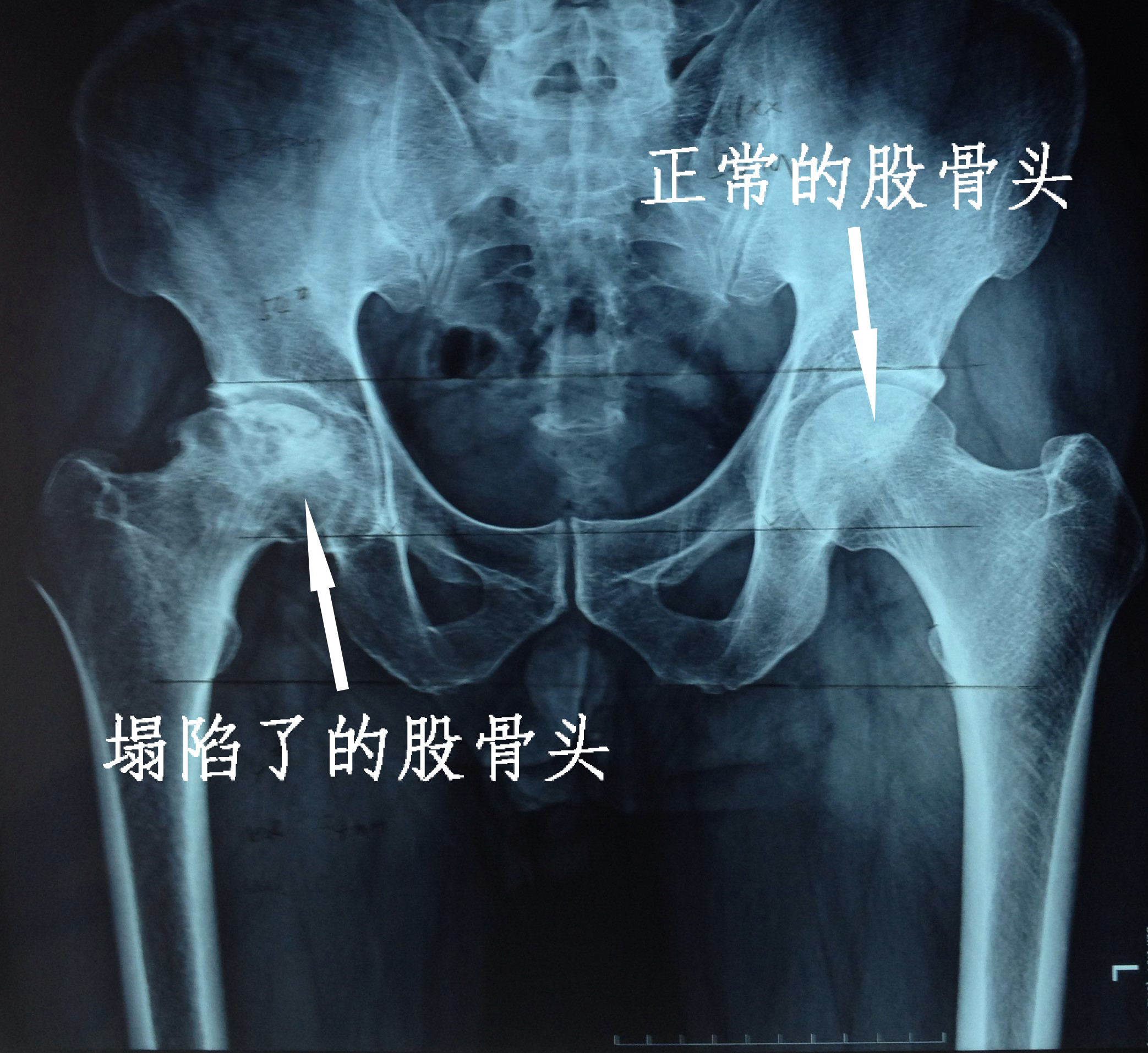 位置图片正常股骨头x光片股骨x线解剖图左股骨内侧髁骨的图片屁股骨头