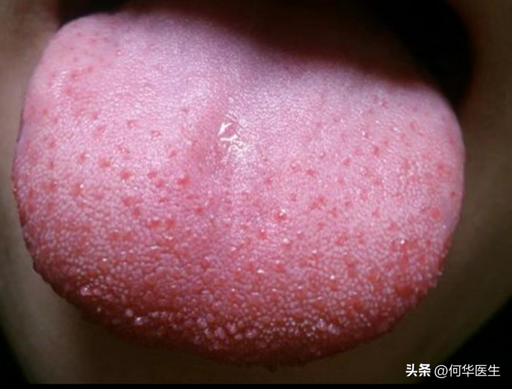 舌头上不正常的红点叫芒刺,赶紧来自查  大家早上起来刷牙照镜子的
