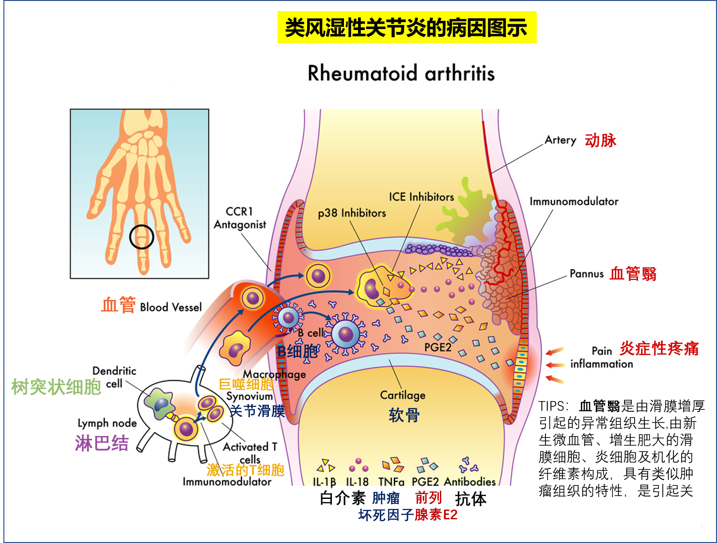 风湿性关节炎图图片