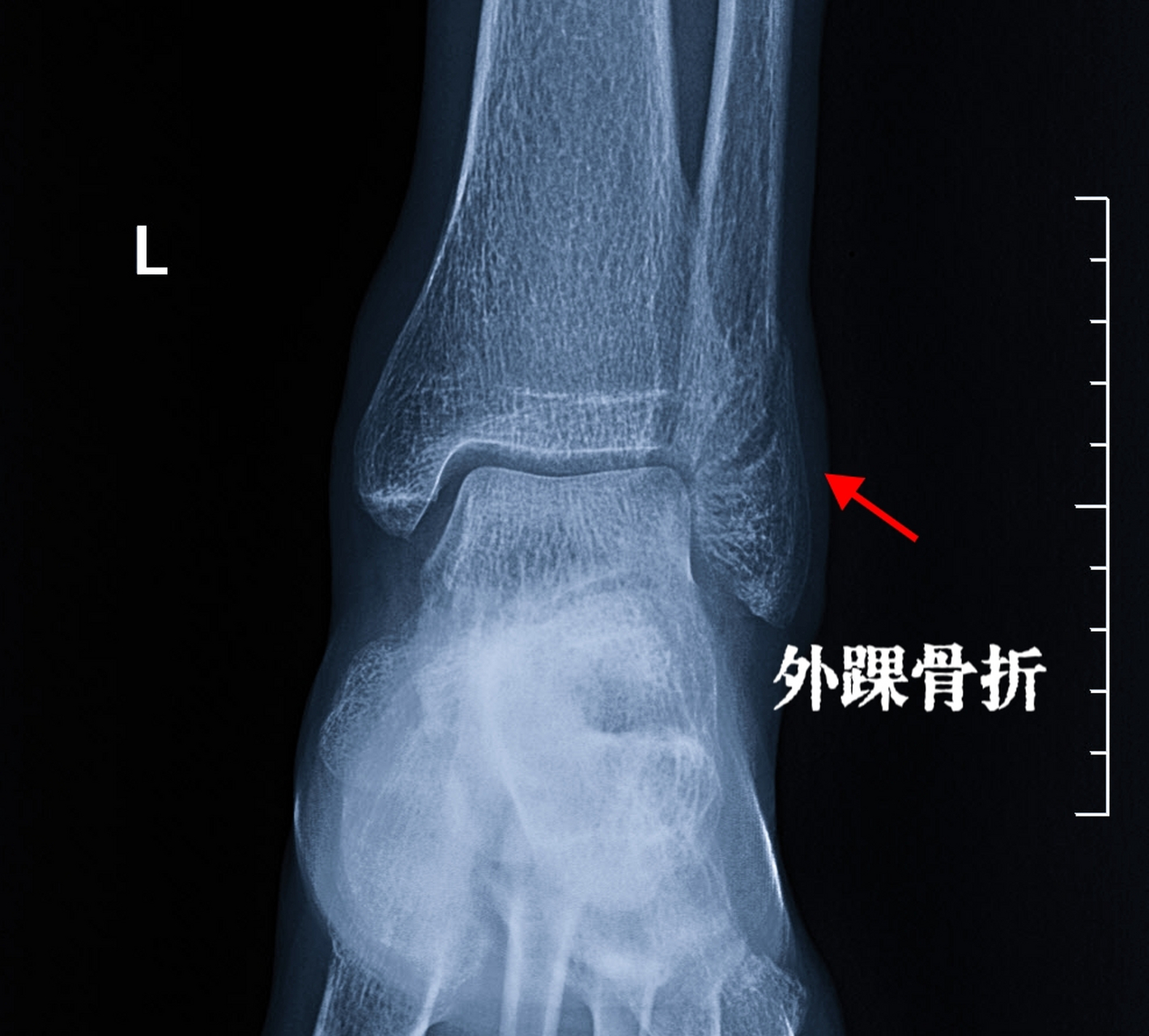 崴脚脖子一个月了,不能正常走路,也没想拍张x线片子……  今天的这位