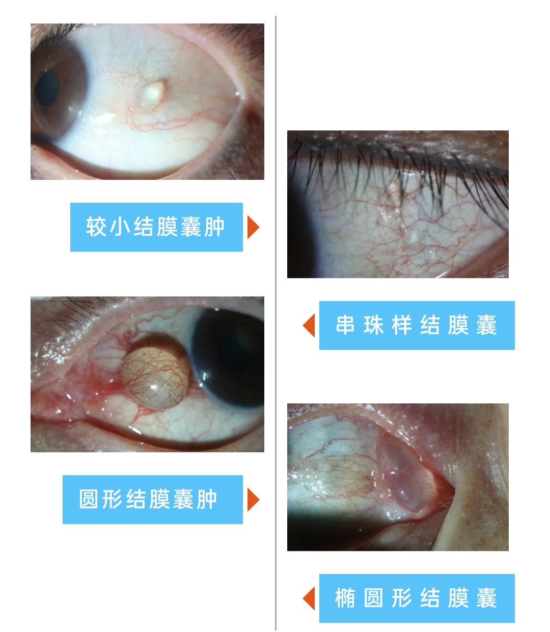 结膜囊肿不可大意