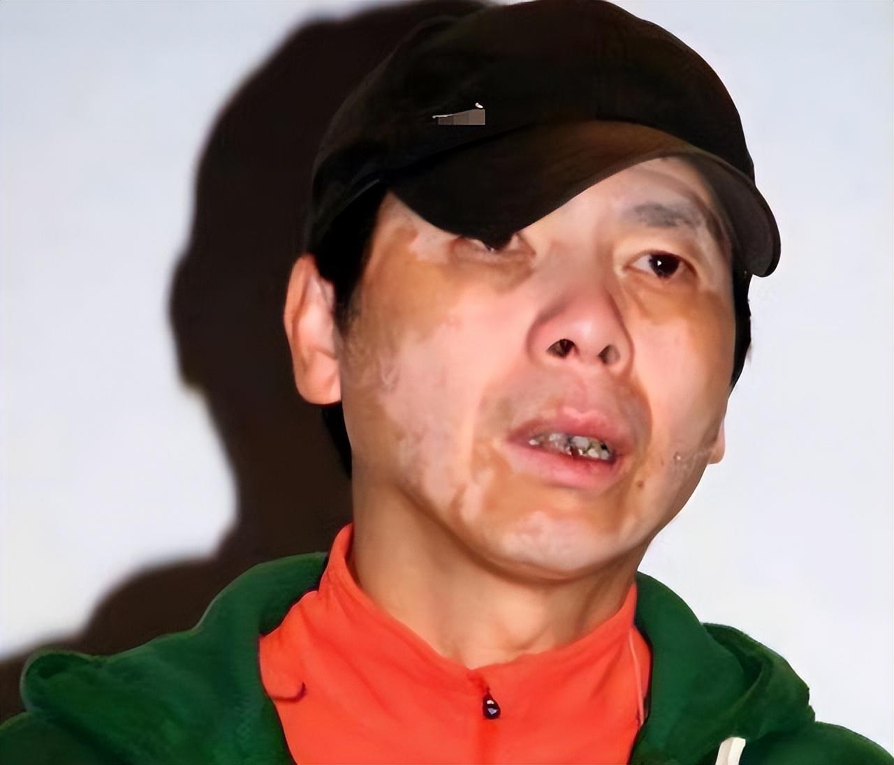 然而,患有白癜风的冯小刚,直至今日,却看不到白斑了.