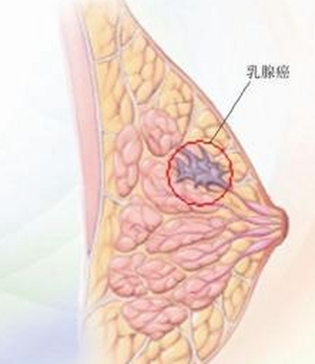 乳腺癌位置图图片