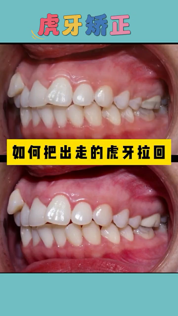 虎牙矫正需要拔牙吗?看完你就明白了