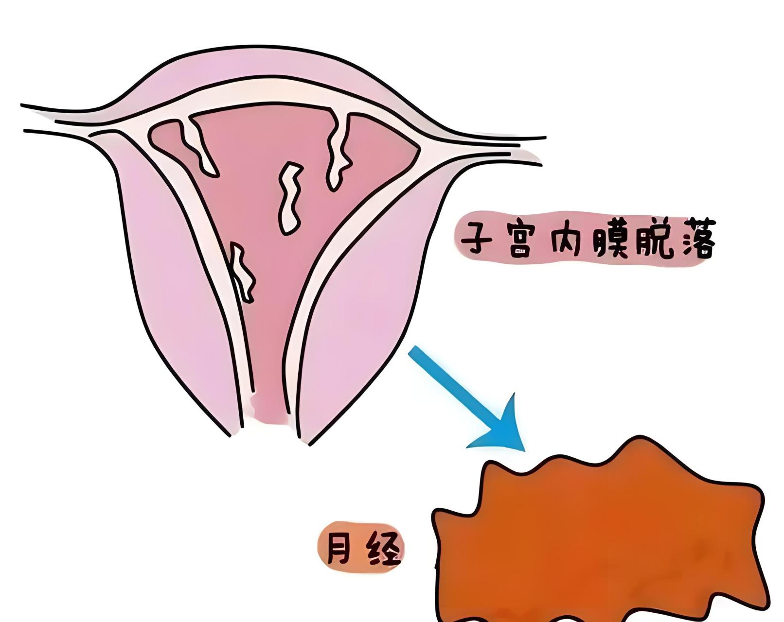 子宫内膜增厚 刮宫图片