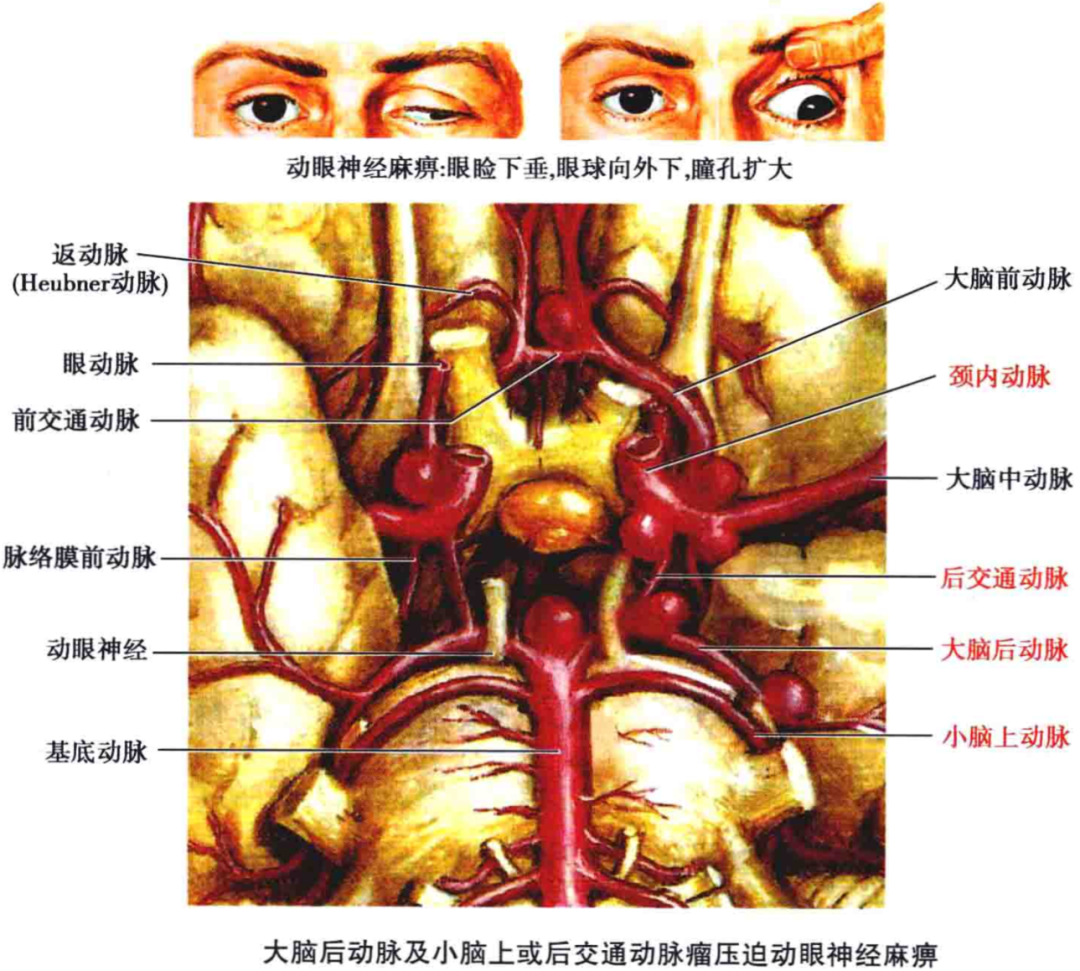 大脑后动脉解剖及病变表现——脑血管解剖