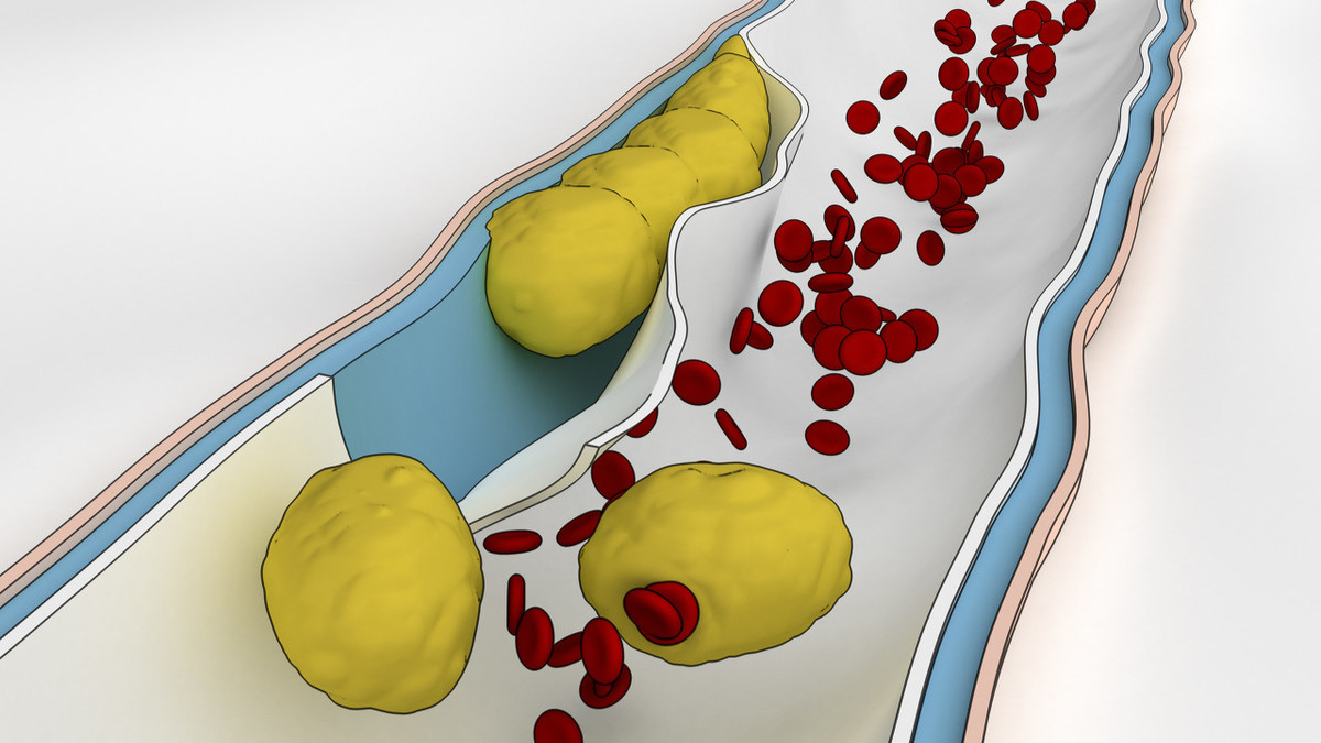 脂蛋白(a)高是怎么回事图片