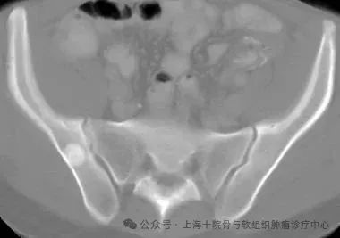 什么是骨岛,体检报告提示骨岛怎么办?