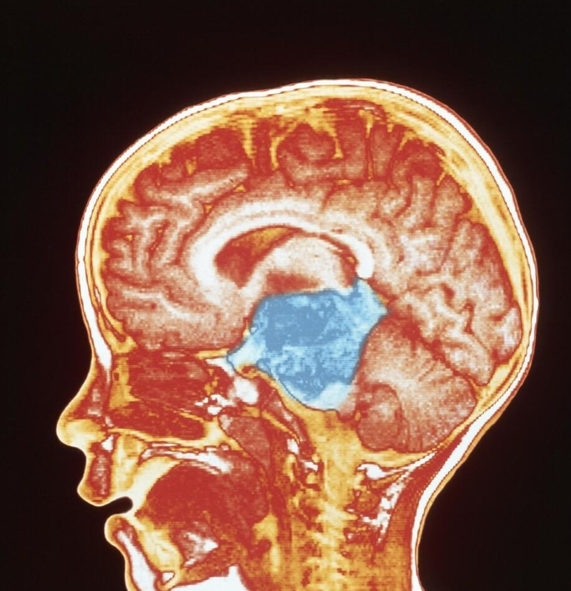 回顾男子头痛以为脑肿瘤开颅后恶臭液体流出医生误诊了