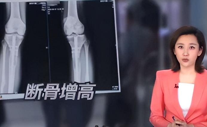 14年20岁北京男孩李亚诺花16万断骨增高72厘米后来怎样