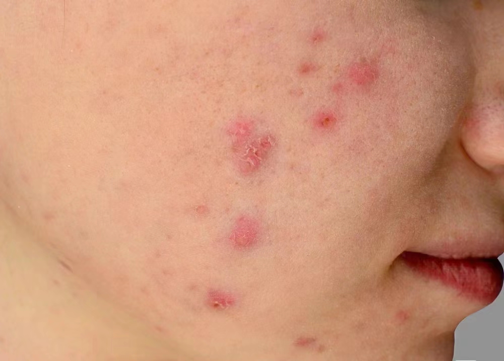 为什么痘痘不挤也留疤