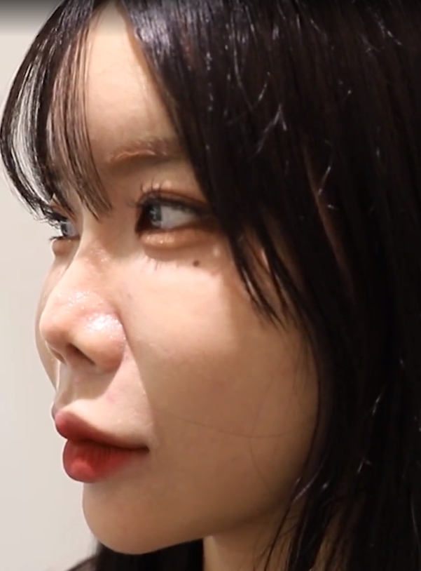 当鼻尖发生包膜挛缩或疤痕挛缩,鼻头就会出现挛缩畸形,修复手术就是