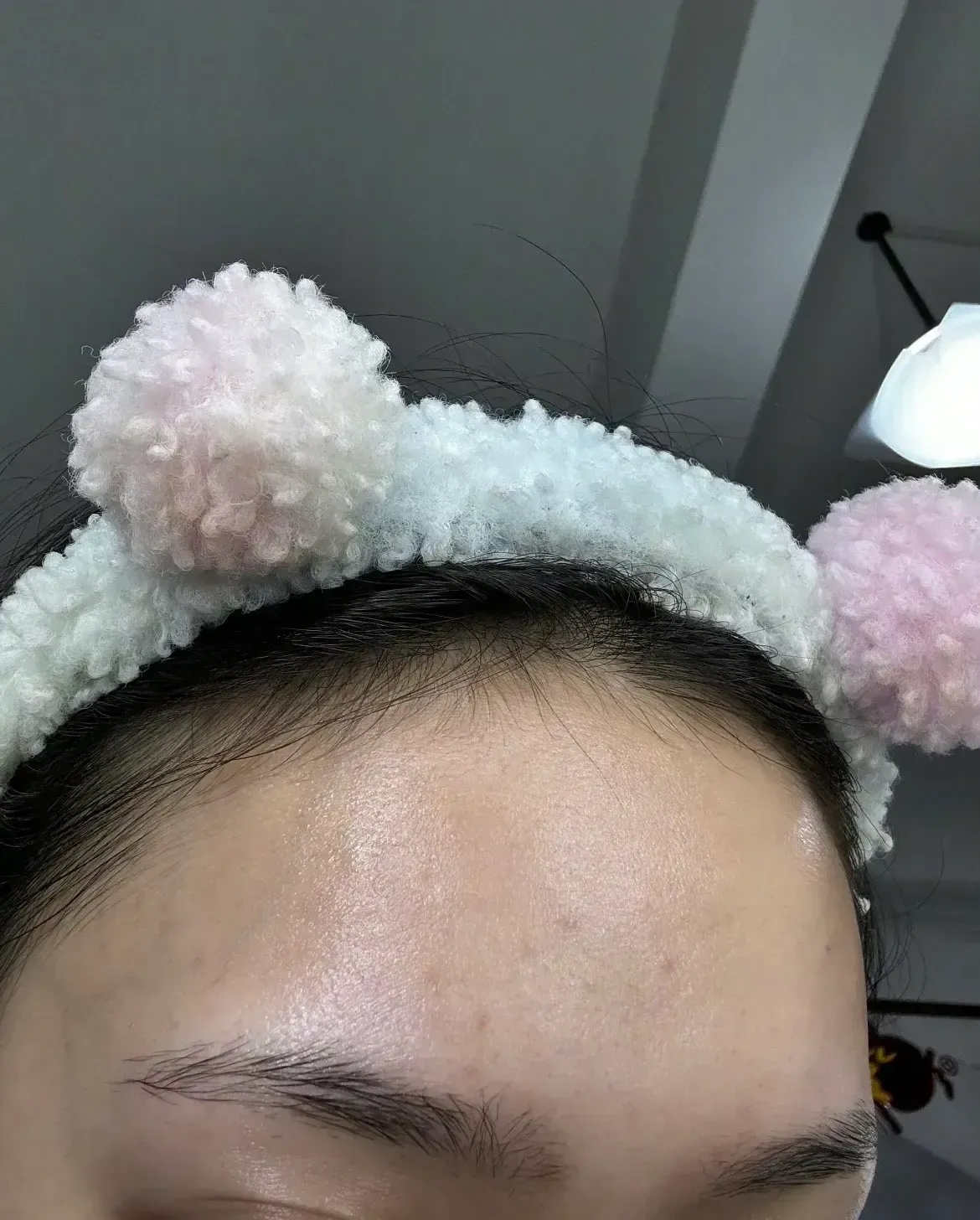 为了消除额头的闭口林允不惜在自己的脸上下了一剂猛药而且一刷