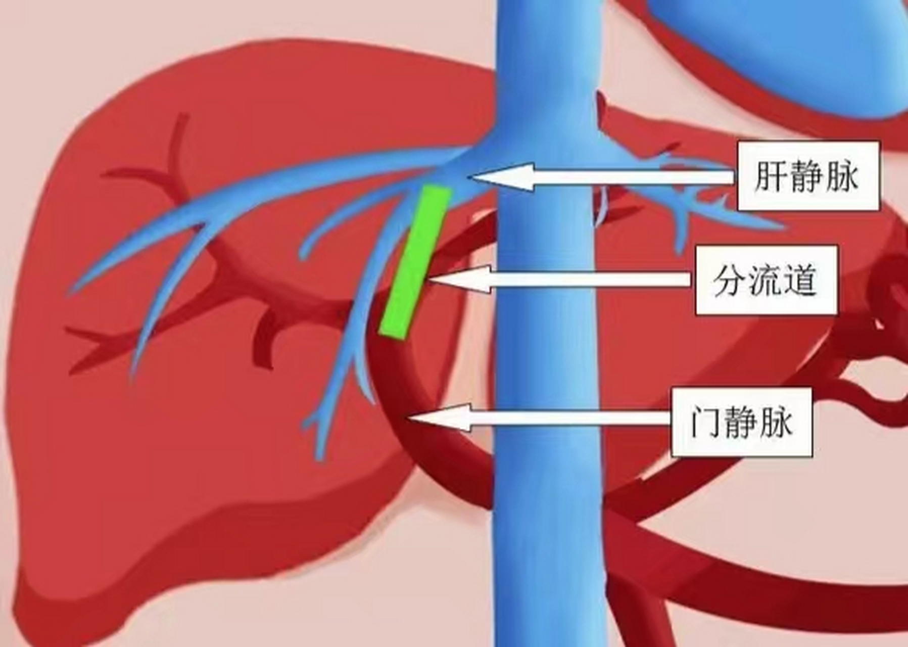 3个小方法,教你轻松改善肝硬化食管胃底静脉曲张!