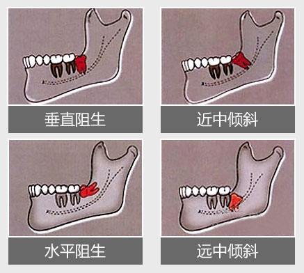 上牙智齿位置图图片