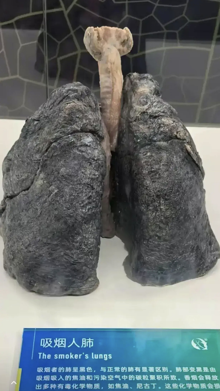 触目惊心,吸了几十年烟的烟民肺既然是这个样子,看完我真不敢抽烟了